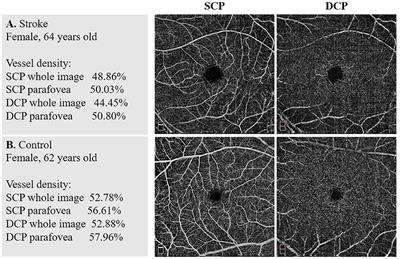 Reduced Retinal Microvascular Perfusion in Patients With Stroke Detected by Optical Coherence Tomography Angiography